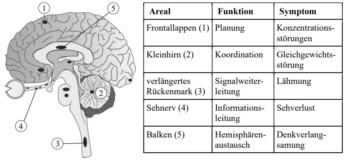 Seitliche Gehirnzeichnung mit nummerierten Bereichen und Tabelle zu Funktionen und Symptomen (Frontal-, Kleinhirn, Rückenmark, Sehnerv, Balken)